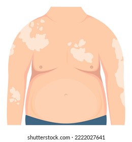 Fat man with vitiligo patches on the skin. Beauty diversity concept, body positive, chronic skin disease awareness, illustration