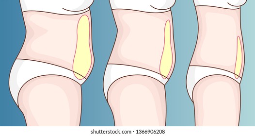 Fat on the belly. Reducing fat in the abdominal area. Overweight.