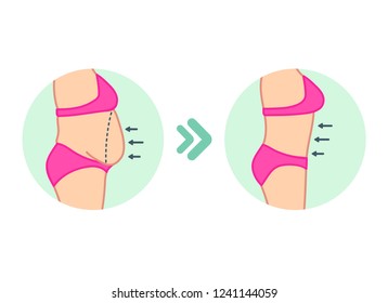 Fat on belly. Tummy before and after diet, fitness or liposuction. Vector illustration of woman belly.