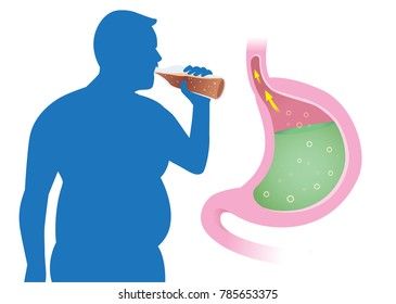 Fat People have acid reflex in stomach from drink carbonated beverages. Illustration about Gastroesophageal reflux disease.