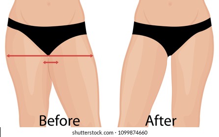 Fat and slim girl's back. Fat thig. Liposuction. Before and after. Woman body correction vector illustration