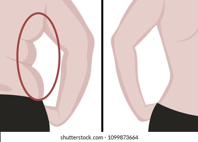 Fat and slim girl's back. Fat waist. Liposuction. Before and after. Woman body correction vector illustration