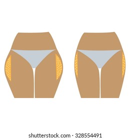 Fat thighs  before and after diet and fitness. Vector illustration on the white background.