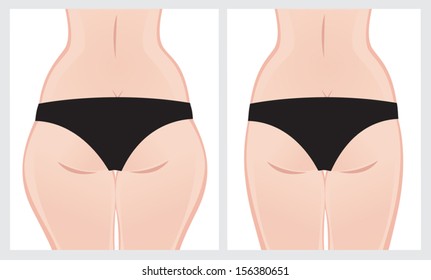 Fat thighs from behind before and after treatment.  Vector image on a white background.