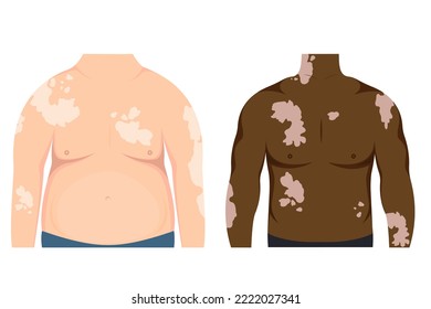  Fat and thin african american man with vitiligo patches on skin. Beauty diversity concept, body positive, chronic skin disease awareness, illustration