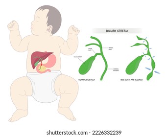 fatal enlarged spleen infection Biliary atresia bile duct blocked Primary acute choledochal cyst stone obstructive damage bilirubin level acid test scan ascites yellowing skin Acholic stool liver pain