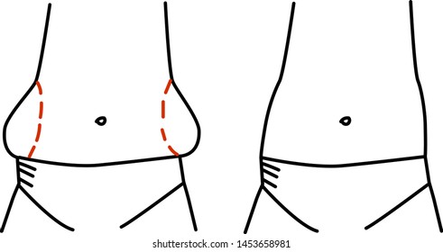 Fatly sides of the body. Vector outline illustration