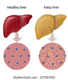 Fatty Liver Disease