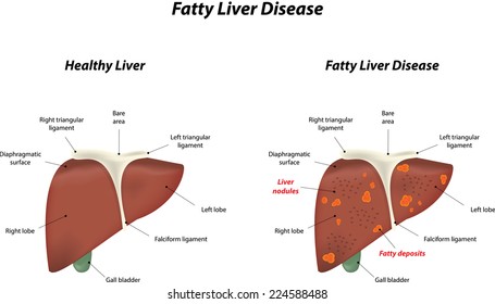 Fatty Liver Disease