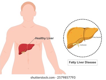 Fatty liver disease is a condition in which fat builds up in liver. medical healthcare, vector illustration.  