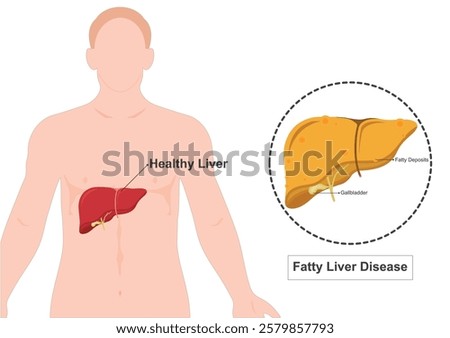 Fatty liver disease is a condition in which fat builds up in liver. medical healthcare, vector illustration.  