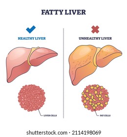 Fatty Liver Disease With Healthy And Damaged Organ Comparison Outline Diagram. Labeled Educational Fat Cells Amount On Alcoholic Or Overweight Body Vector Illustration. Anatomical Illness Explanation.