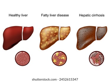 Hígado graso. Cirrosis hepática. Primer plano de la histología. Aumento de hepatocitos normales y células de hígado graso y cirrosis. Ilustración vectorial