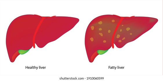 Fatty Liver And Healthy Liver