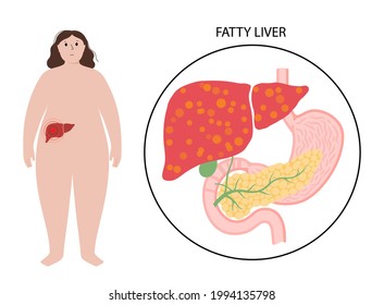 Fatty Liver Logo. Liver Disease, Non Alcoholic Steatohepatitis Concept. Pain And Inflammation In Obese Female Body. NASH Poster Flat Vector Illustration. Scarring And Damaging In Human Internal Organs