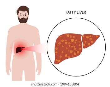 Fatty Liver Logo. Liver Disease, Non Alcoholic Steatohepatitis Concept. Pain And Inflammation In Digestive System. NASH Poster Flat Vector Illustration. Scarring And Damaging In Human Internal Organs.