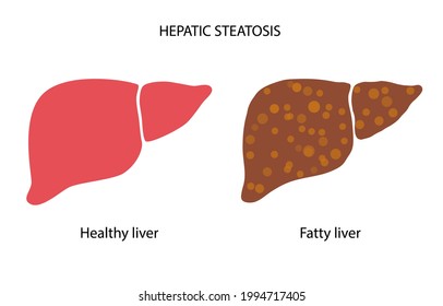 Fatty liver logo. Liver disease, non alcoholic steatohepatitis concept. Healthy and damaged human internal organ. Pain and inflammation in the digestive system. NASH medical poster vector illustration