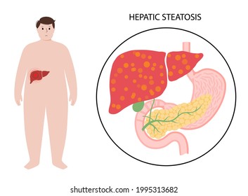 Fatty Liver Logo. Liver Disease, Non Alcoholic Steatohepatitis Concept. Pain And Inflammation In Obese Male Body. NASH Poster Flat Vector Illustration. Scarring And Damaging In Human Internal Organs.