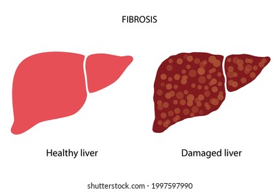 Fatty Liver Logo. Liver Disease, Non Alcoholic Steatohepatitis Concept. Healthy And Damaged Human Internal Organ. Pain And Inflammation In The Digestive System. NASH Medical Poster Vector Illustration