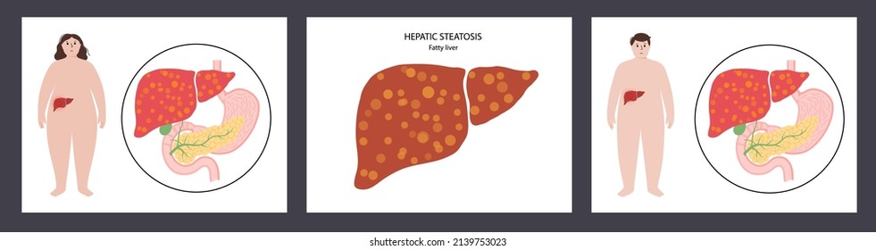 Fatty Liver Logo. Liver Disease, Non Alcoholic Steatohepatitis Concept. Pain And Inflammation In Obese Female Body. NASH Poster Flat Vector Illustration. Scarring And Damaging In Human Internal Organs