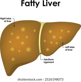 Fatty Liver Right And Left Lobe of Liver Falciform Ligament Vector Illustration