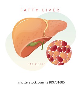 Fatty Liver - Stock Illustration as EPS 10 File