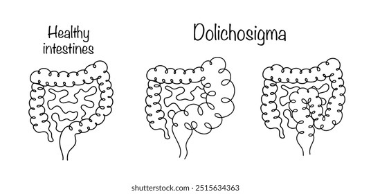 A feature in which the length of the sigmoid colon is higher than normal. Dolichosigma leads to a deterioration in the peristalsis of the large intestine and disruption of its regular emptying.