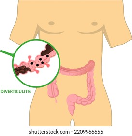 Fecal Exam Sigmoid Diet Blocked Test C. Diff Stoma Swelling Disorder Peritonitis Rectal. Bowel Colon Cancer And Crohn's Disease Polyp Hernia Rectum Diverticula Ulcer Blood Stool Pain 