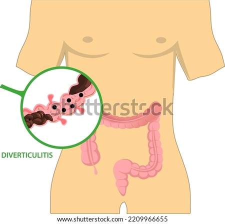 Fecal exam sigmoid diet blocked test C. diff stoma swelling disorder peritonitis rectal. Bowel colon cancer and crohn's disease polyp hernia rectum diverticula ulcer blood stool pain 
