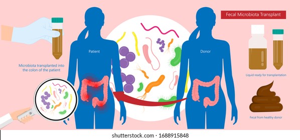 Fecal microbiota transplant FMT IBD IBS bowel colon tract stool small large flora enema donor tube CDI C.diff