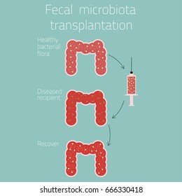 Fecal microbiota transplantation. Medical concept. Vector illustration.