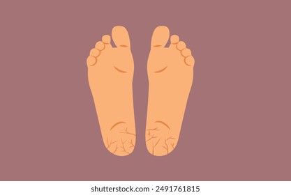 
Feet with Cracked Heels Vector Conceptual Illustration. Damaged skin on barefoot person medical drawing 
