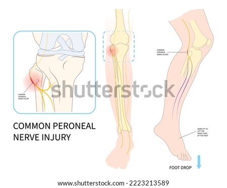 feet drop palsy leg injury and ankle pain Trauma spine lower damage brain Stroke flex Atrophy lift tibial loss fibular Neck bone common cervical spinal cord test sciatic nerve muscle deep knee Stock photo © 