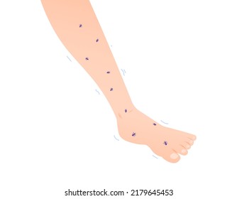 Feet Felt Like Being Swarmed By Ants. Symptoms Of Tingling, Tremor, Leg Paralysis And Numbness. Legs Shaking And Sore. Health Problem. Character Illustration Design