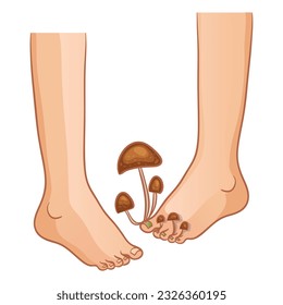 Feet with fungal infection, concept illustration with growing mushrooms, vector image, eps10