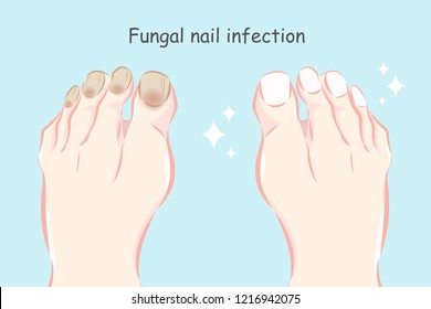 Feet Fungal Nail Infection Before After Stock Vector (Royalty Free ...