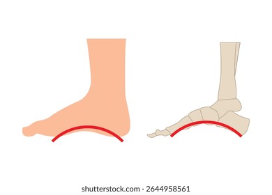 Feet with too high arches, feet with high arches