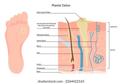 Füße plantare callus. Geschwollene Haut mit rauem, gelblichem, lumphalem Hautpflaster. Medizinischer Kleberputz für den Callus. Leichtschuhe Ergebnis. Flache Vektorgrafik