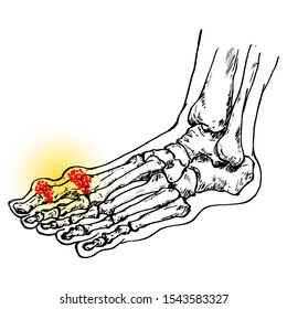 A feet skeleton with a throbbing swollen big toe with concentration of uric acid particles. Hand drawn vector illustration.