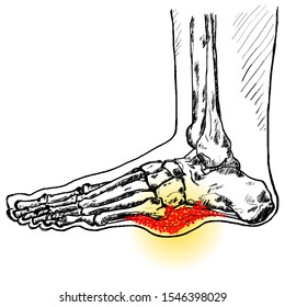 A Feet Skeleton With A Throbbing Swollen Foot Sole With Concentration Of Blood Clot Indicating Plantar Fasciitis Injury. Hand Drawn Vector Illustration. 