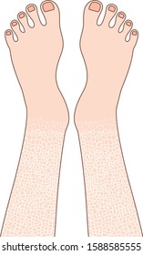 The feet which has dried skin, with outlines.