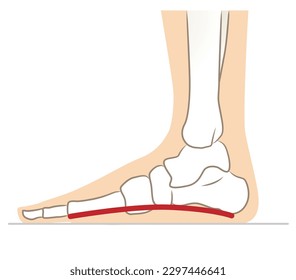 Feet without arches, feet with flat feet