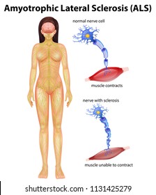 Female Amyotrophic Lateral Sclerosis Illustration