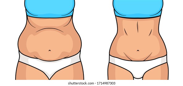 Female belly fat loss plastic surgery. Abdomen fatty girl abs lose before and after cellulite