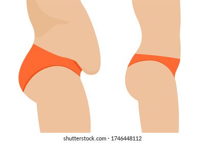 Female belly fat loss plastic surgery. Abdomen fatty girl abs lose before and after cellulite