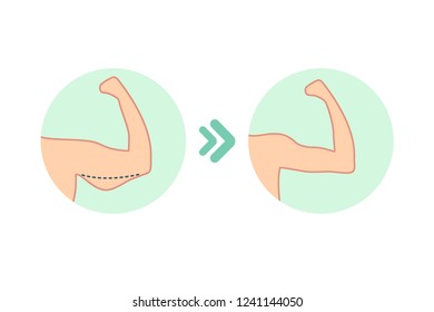 Female biceps before and after sport. Vector illustration of woman body problem. Fat and slim figure, before and after weight loss. Female biceps.