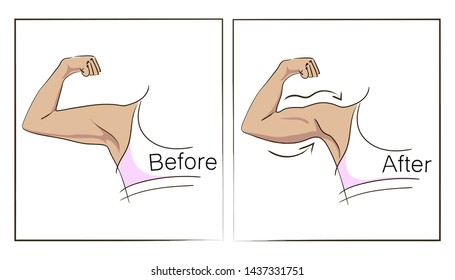 Female biceps and triceps before and after sport. Arms showing progress after fitness. Bent arm with bat wing vs well toned arm. Vector illustration for beauty, cosmetology, sport or medicine infograp