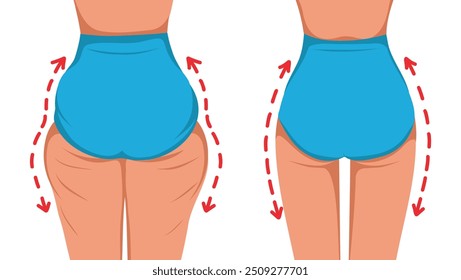 Female body before and after. Lose weight in the hip area. Vector template for advertising, website, banner, posters, cover