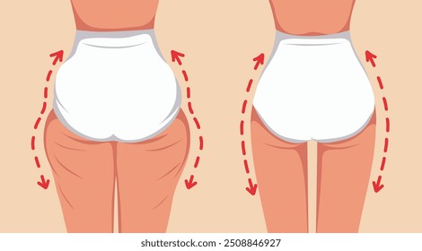 Female body, hips before and after weight loss and massage. Vector template for advertising, website, banner, posters, cover