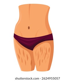 Female body with stretch marks on thighs, concept of body positivity and acceptance